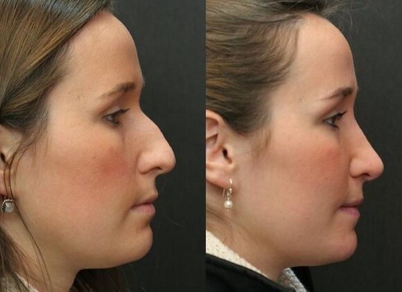 Before and after not -buturgical rhinoplasty
