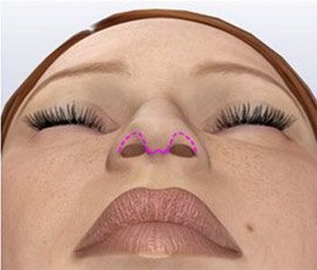 Nasal correction