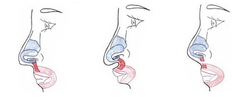 Cutting part of the nasal muscle