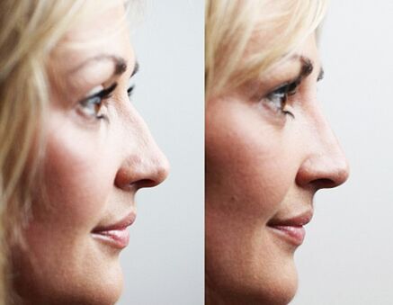 Before and after rhinoplasty with fillers