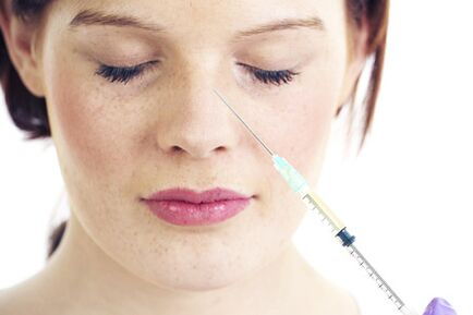 Non-operative rhinoplasty with fillers