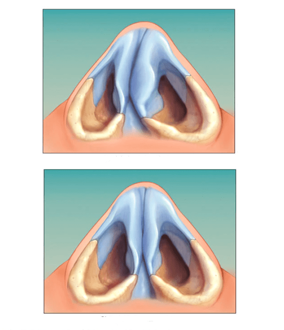 corrected nasal septum