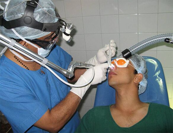 septum correction using a laser scalpel