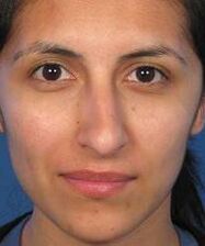 The incorrect shape of the nose is a reason for plastic surgery