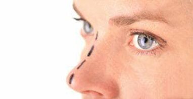 Marking of the nose for placement of cosmetic sutures