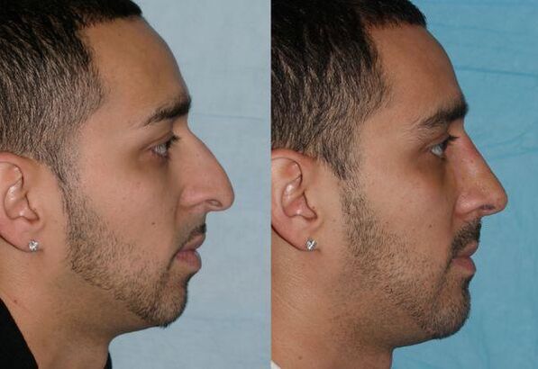 nose correction in men