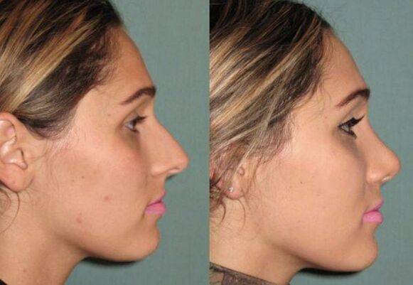 result of non-injectable rhinoplasty