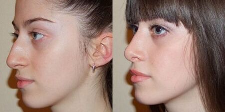 photos before and after rhinoplasty of the nose