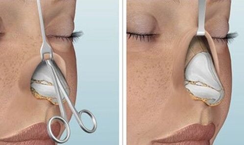 rhinoplasty with an open nose
