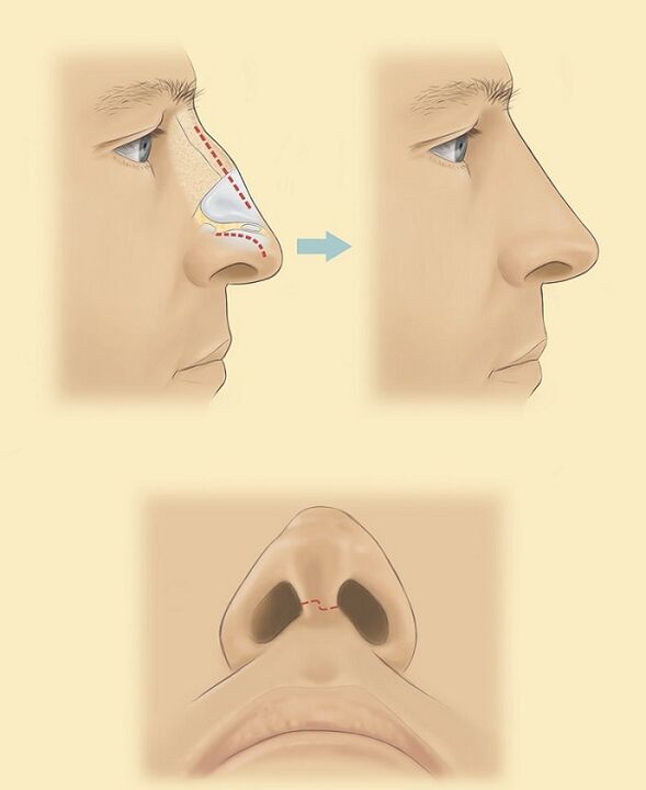 scheme for rhinoplasty of the nose