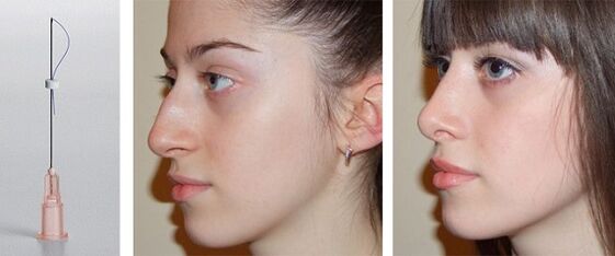 before and after rhinoplasty with mesons