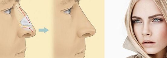 correction of the shape of the nose with non-surgical rhinoplasty