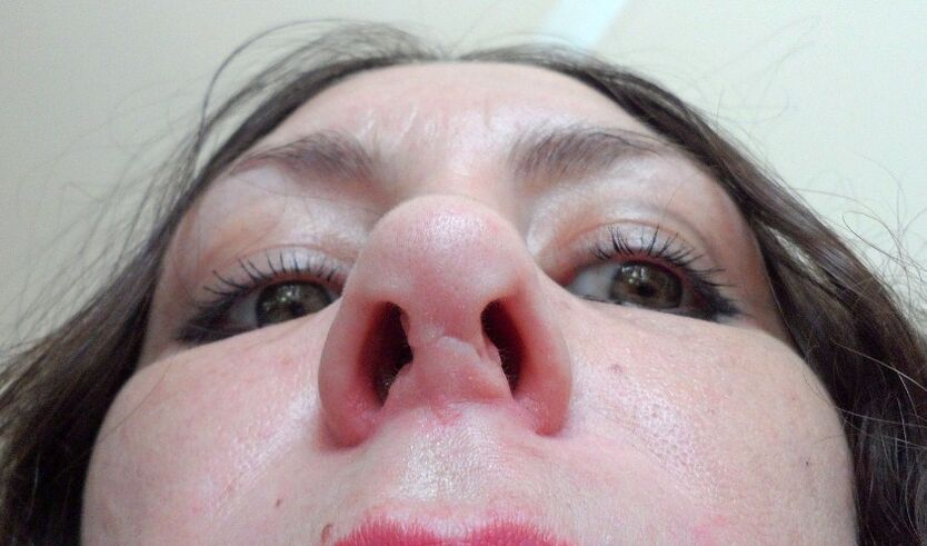 A scar on the nose after a failed rhinoplasty is the reason for a second operation