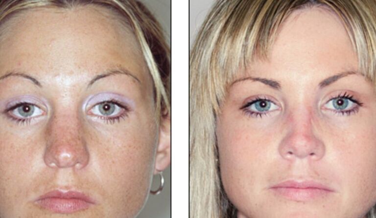 Before and after unsuccessful rhinoplasty of the nose