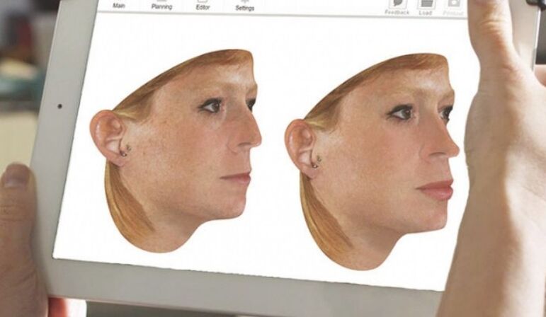 Method for computer modeling of the nose before rhinoplasty