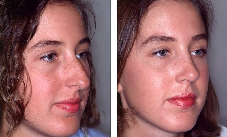 Nose before and after unsuccessful rhinoplasty
