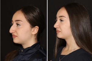 Straightening the nose after rhinoplasty result