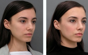 The girl's nose before and after rhinoplasty